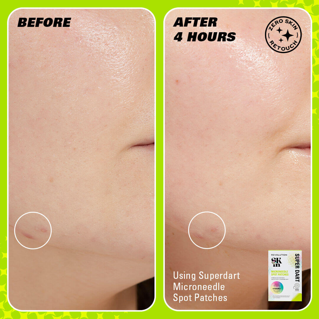 Revolution Skin Super Dart Microneedle Salicylic Acid Hydrocolloid Spot Patches