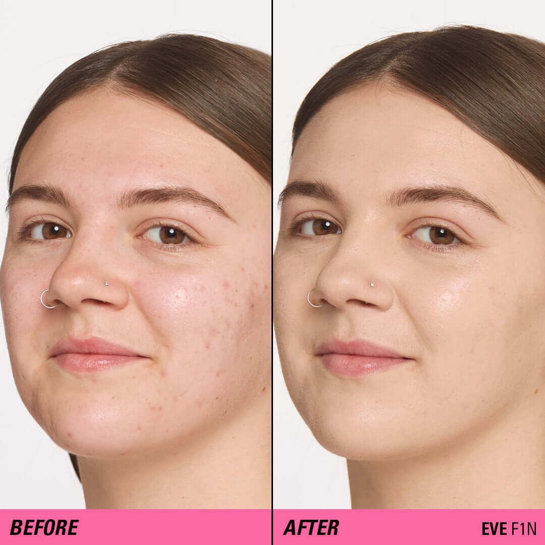 Before and after using Revolution Superfix Blur Longwear Foundation on skin with visible blemishes.