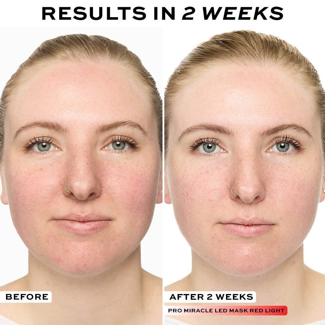 Before and after results of Revolution Pro Miracle LED Face Mask in 2 weeks, showing improved skin clarity.