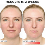 Before and after results of Revolution Pro Miracle LED Face Mask in 2 weeks, showing improved skin clarity.