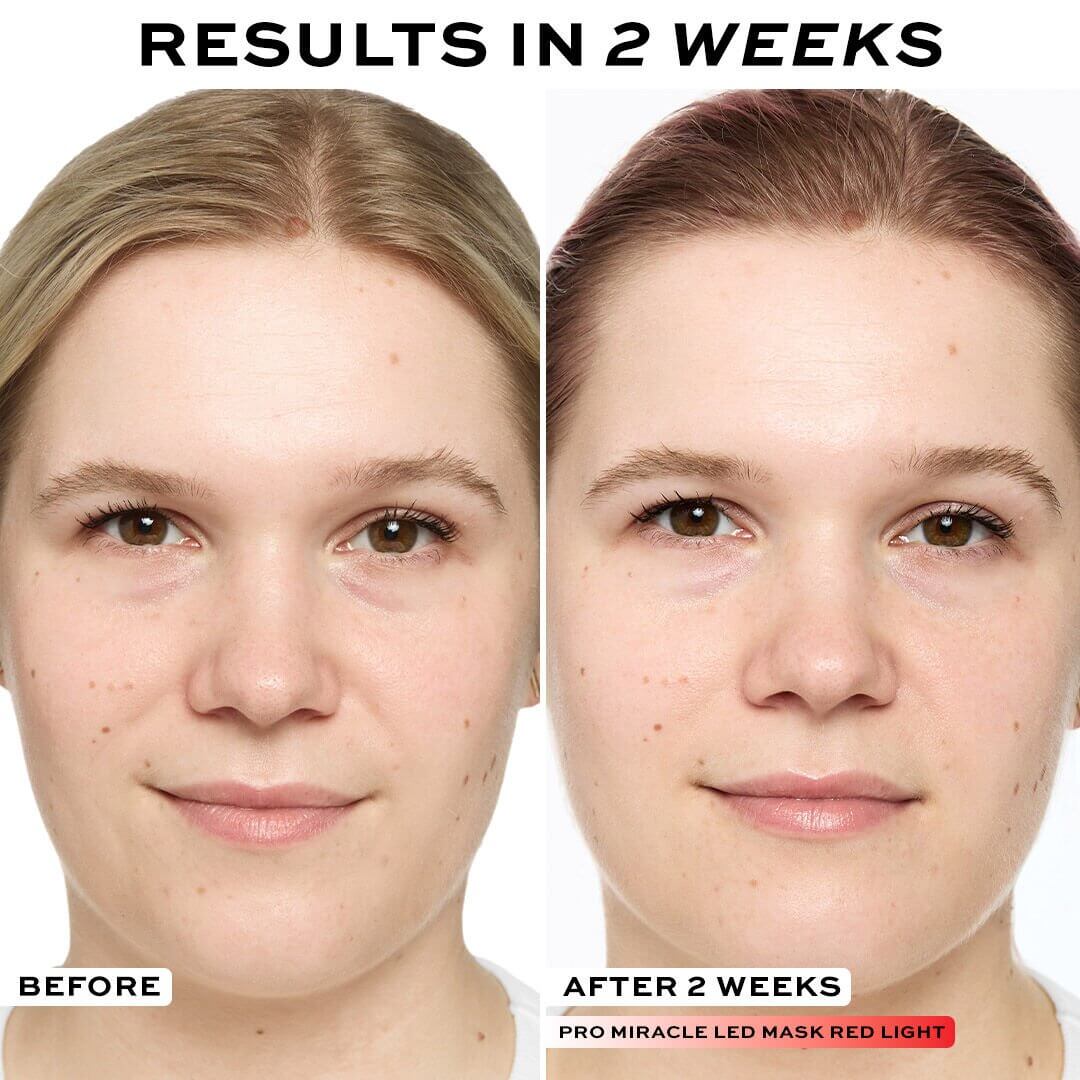 Before and after results in 2 weeks using Revolution Pro Miracle LED Face Mask for skin improvement.