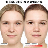 Before and after results in 2 weeks using Revolution Pro Miracle LED Face Mask for skin improvement.