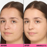Before and after using Revolution Superfix Blur Longwear Foundation on skin with blemishes and redness.