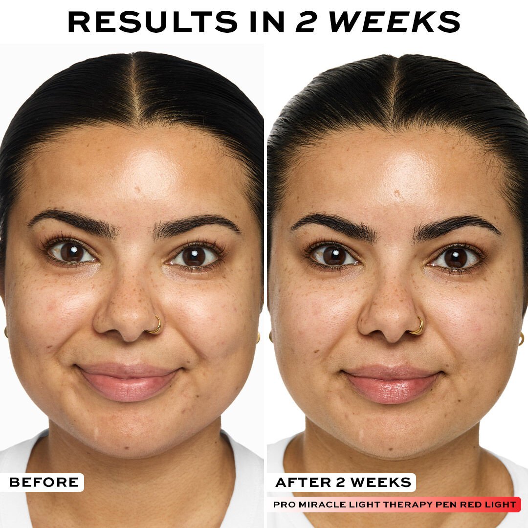 Revolution Pro Miracle LED Light Therapy Pen